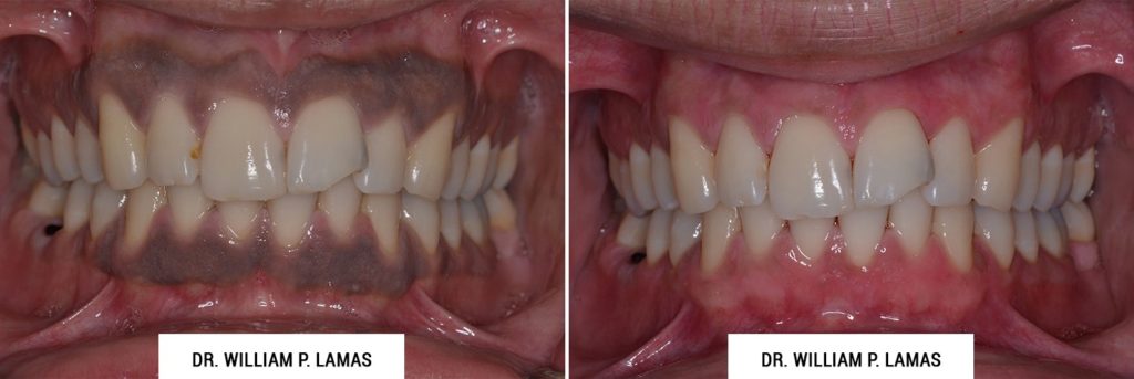 Dark Gum Depigmentation Before & After Photo - William P. Lamas, DMD - Periodontics & Dental Implants. Address: 2645 SW 37th Ave Suite 304, Miami, FL 33133 Phone: (305) 440-4114