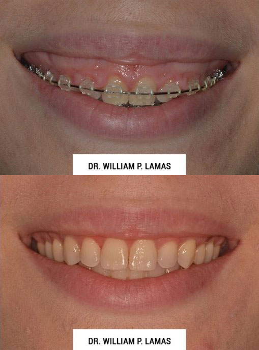 Crown Lengthening Before & After Photo